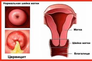 Cervicitis of the cervix: symptoms and treatment
